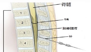 经腰椎穿刺收罗脑脊液.jpg